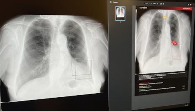 Carebot údajně přináší pokrok v plicní diagnostice Nemocnice Tábor